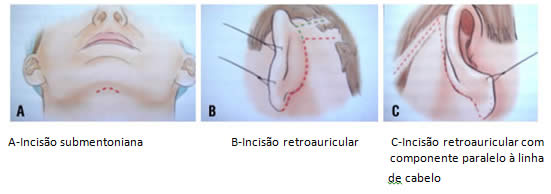 img_cervicoplastia02