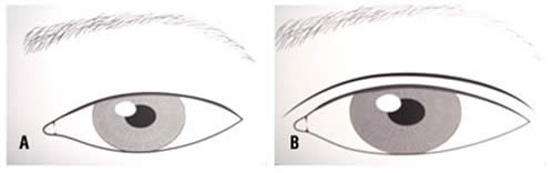 A – Sem a prega – B – Com a prega