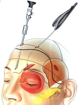 A cirurgia é realizada por videoendoscopia, através de pequenas incisões