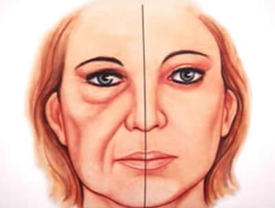 Resultado após ritidoplastia facial associada ao tratamento frontal, com reposicionameto das sobrancelhas