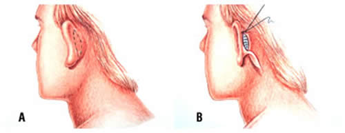 A e B – Local da incisão, atrás da orelha