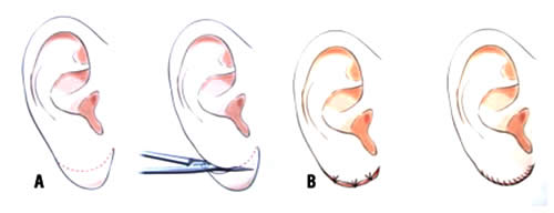  – Lóbulo grande sendo reduzido / B – Após sutura, com o lóbulo já diminuído