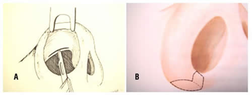 A – Incisão interna / B – Incisão na asa nasal