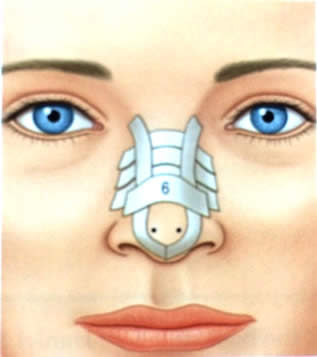 Curativo nasal com micropore