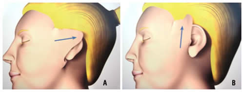 A- Tração mais horizontal / B- Tração mais vertical