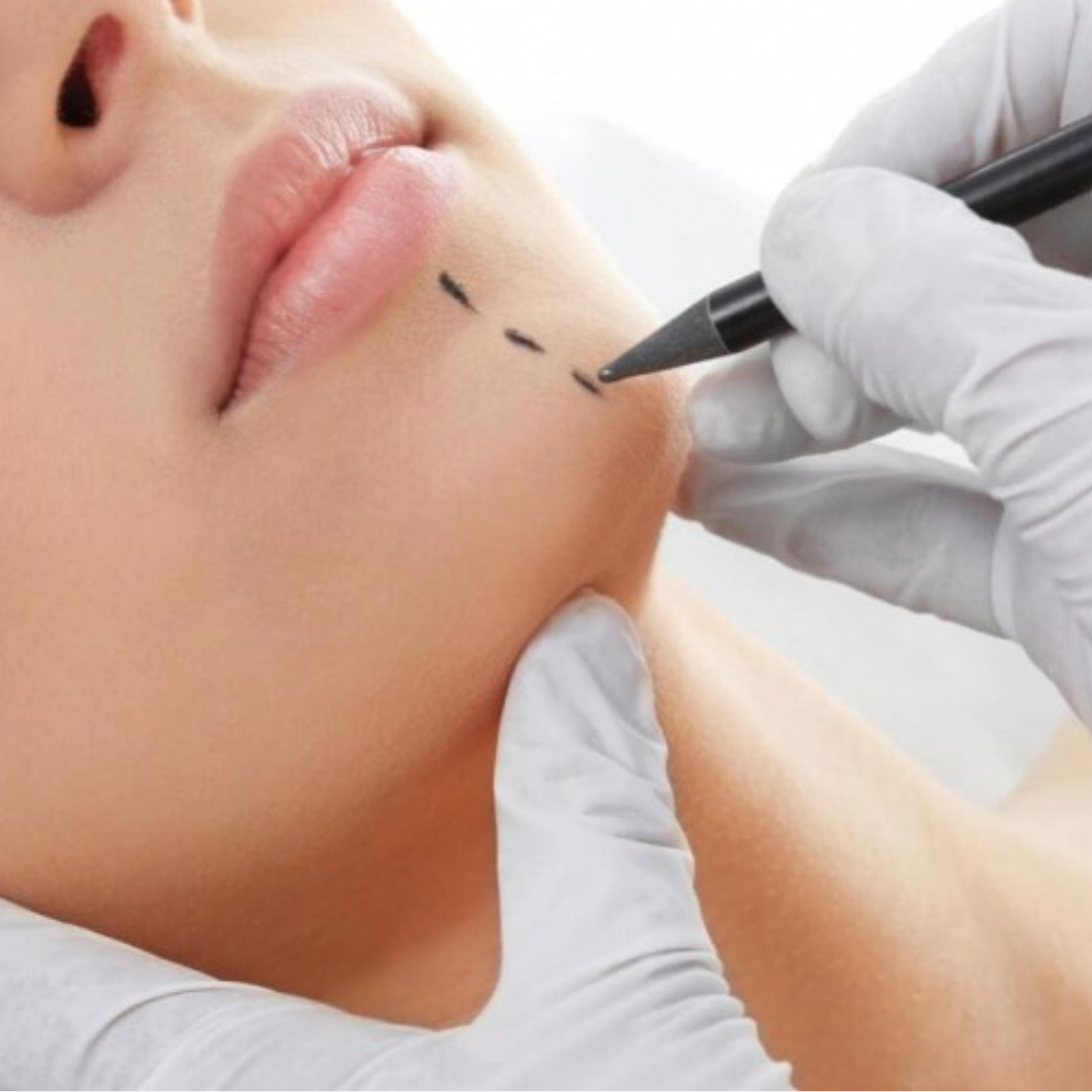 Imagem sobre Mentoplastia (queixo)