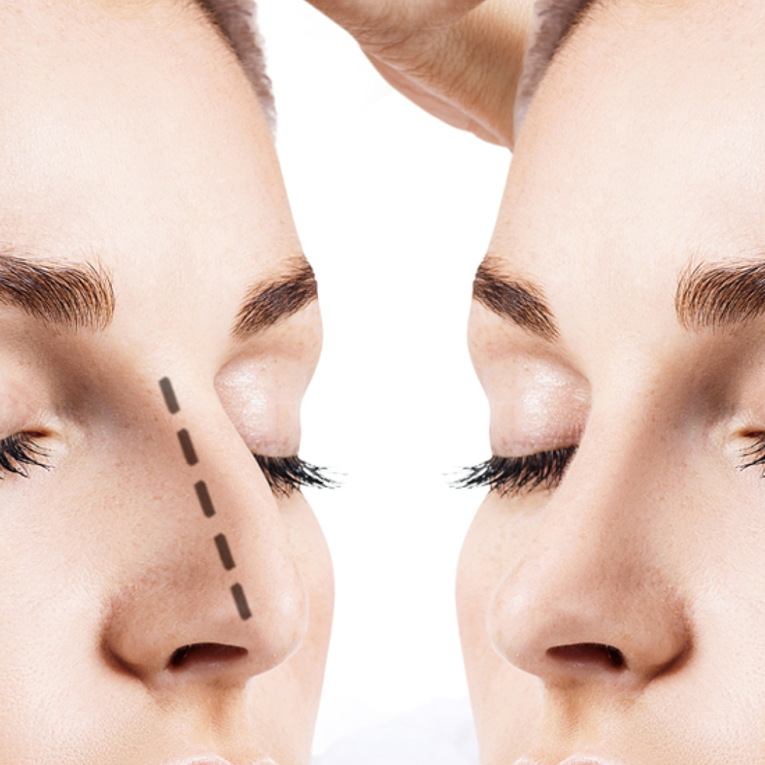 Imagem sobre Rinoplastia (nariz)